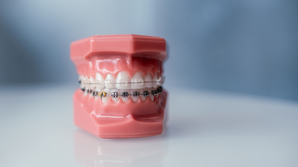 ortodoncija zagreb, invisalign aparatić za zube, prozirne udlage za zube, fiksni aparatić za zube